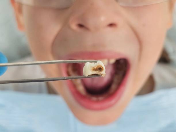 Best Emergency Root Canal Treatment in Coburg, OR