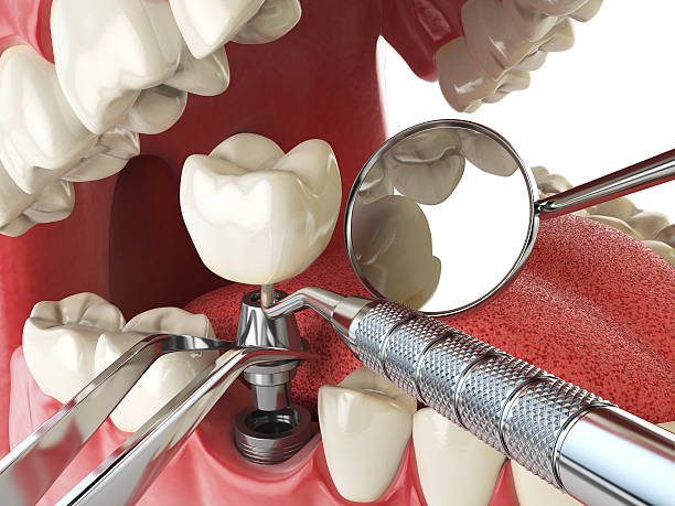 Best Emergency Dentist for Knocked-Out Tooth in Coburg, OR